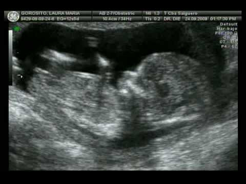 Ecografia De 14 Semanas De Embarazo Nina Habitos De Ninos