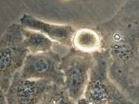 No advancement in Technology when it comes to Cancer English: Cancer cells photographed by camera a...