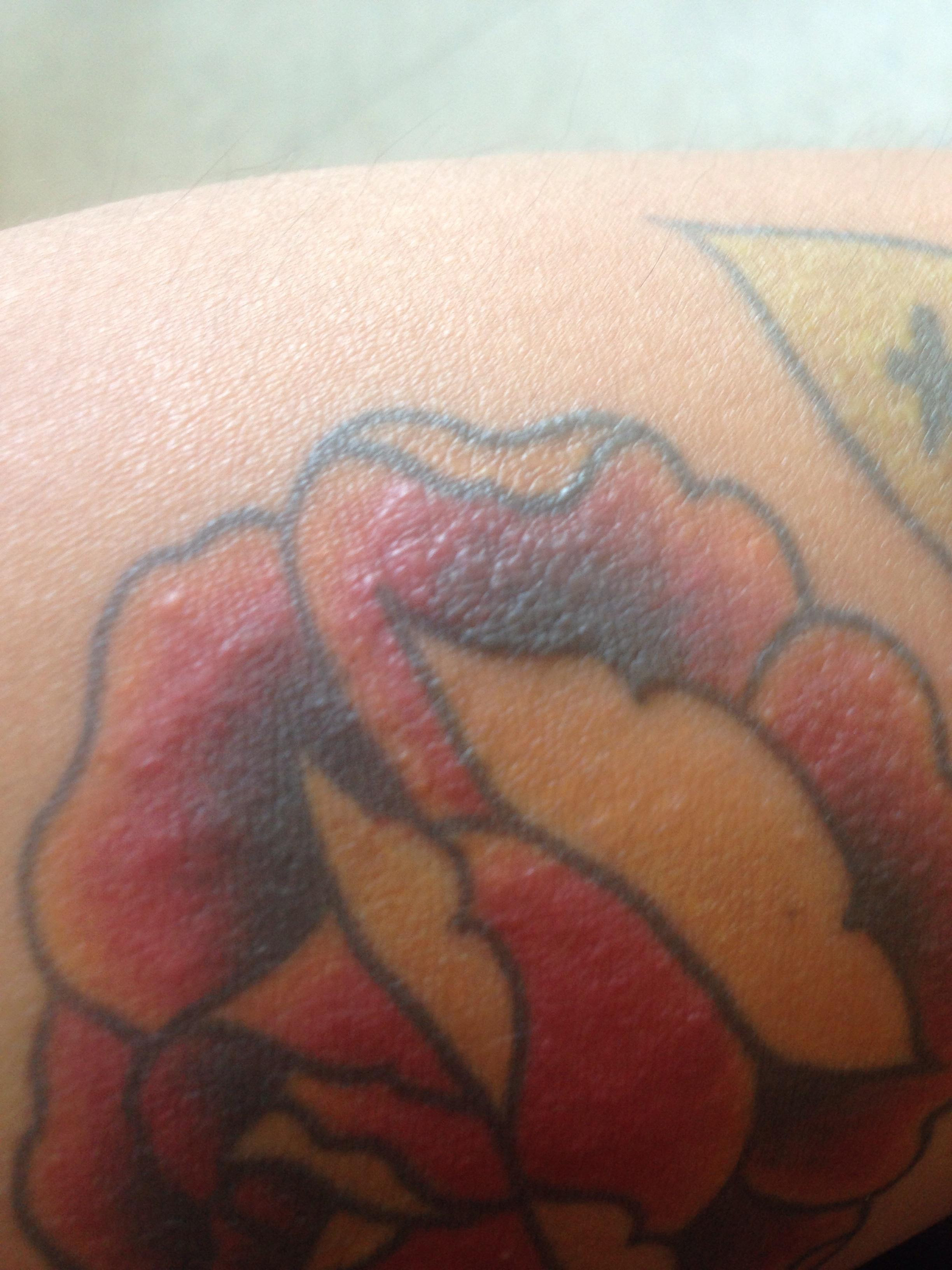Why Is My Tattoo Itchy And Bumpy After A Year