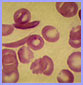 microscopic photo of sickle-shaped cells