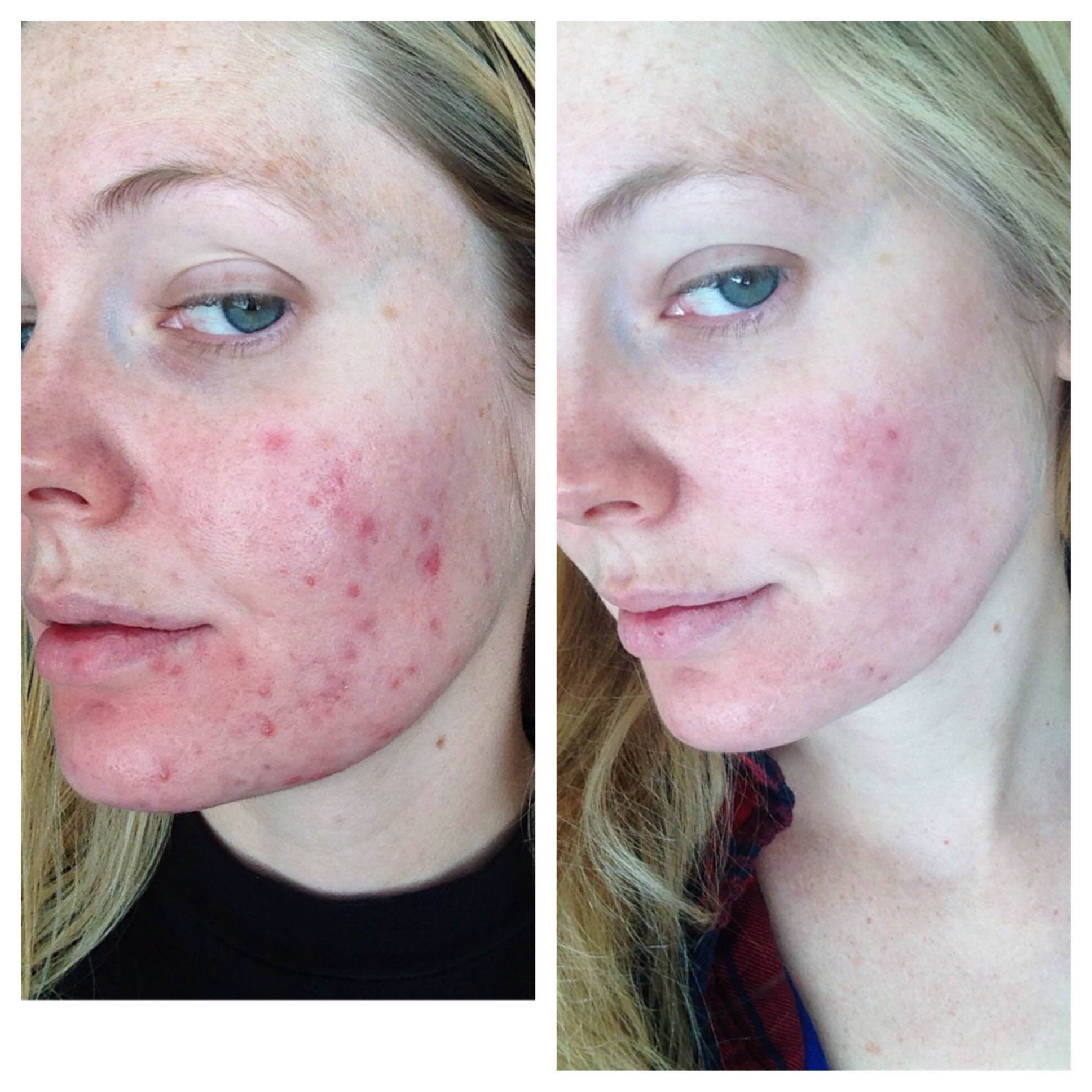 How to get rid of atrophic acne scars reddit