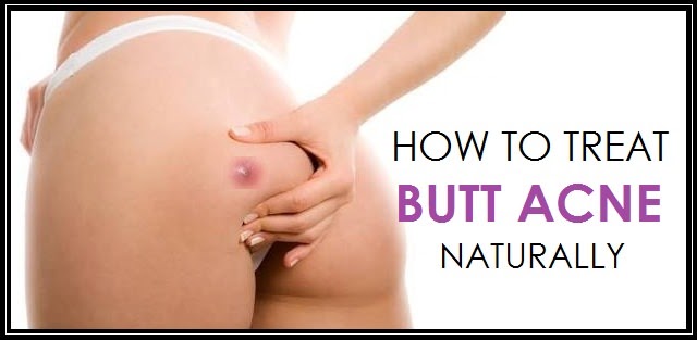 How To Treat Butt Acne Naturally