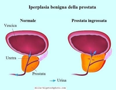 prostata dura al tatto