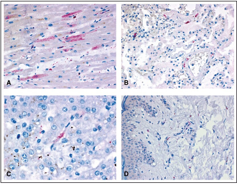 The figure displays four slides showing yellow fever virus antigens detected after immunohistochemical staining in tissue samples from various organs of a patient who died from yellow fever vaccine-associated viscerotropic disease in Oregon during September 2014.