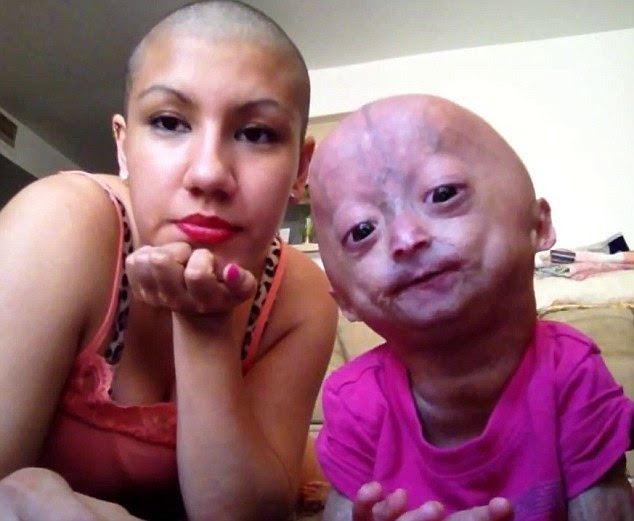 'Angel': Six-year-old Adalia Rose Williams, who suffers from the rare condition progeria, with her mother Natalia Amozurrutia