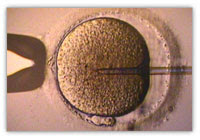 Injecção do espermatozóide e retirada da micro...