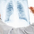 Viral Pneumonia: Symptoms, Risk Factors, and More
