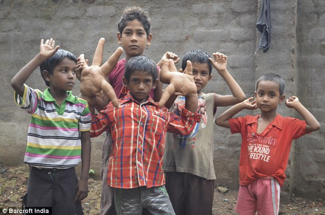 Doctors in India have been left baffled by his growing hands and many are at a loss as to what the condition is