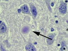 Micrograph of brain cells containing a Lewy body, the light purple sphere indicated with the arrow