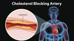 Cholesterol Blocking Artery: a upper body shown with the arteries - one artery enlarged labeled cholesterol