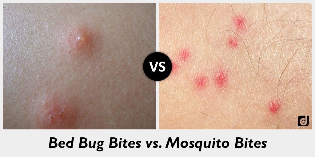 Are Bed Bugs Like Mosquito Bites Whadoq
