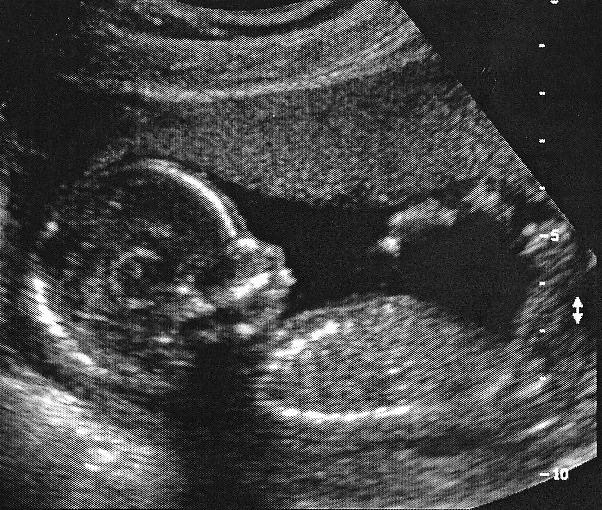 ultrasound 21 Nov 