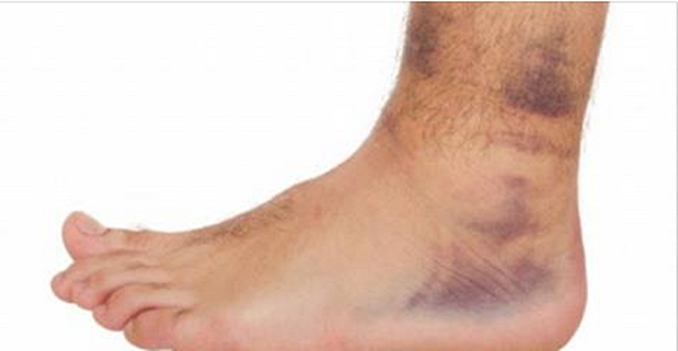mast u gležnju faze liječenja artroze koljena