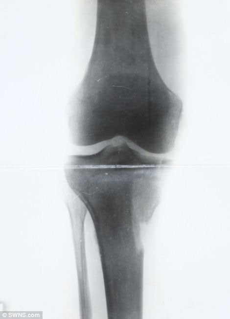 After he was shot in the leg in 1917, these x-rays were taken of his leg and are thought to have been carried out by Marie Curie, who had a mobile unit where he was treated