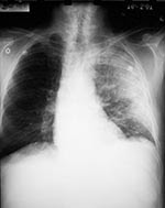 Thumbnail of Chest X-ray (Case 2) showing diffuse consolidation consistent with pneumonia throughout the left lung. There is no evidence of mediastinal widening.