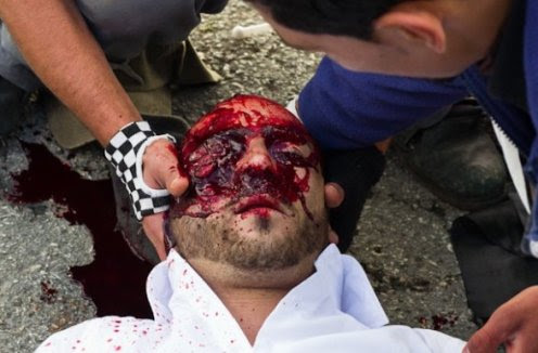Nabi saleh-Mustafa Tamimi after being shot in the face with a high-velocity tear gas canister from short range -photo Lazar Simeonov