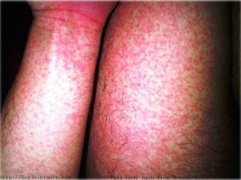 10 Dengue Fever Symptoms 1. Pale or Flushing Pink Rash e1316540143575 10 Dengue Fever Symptoms