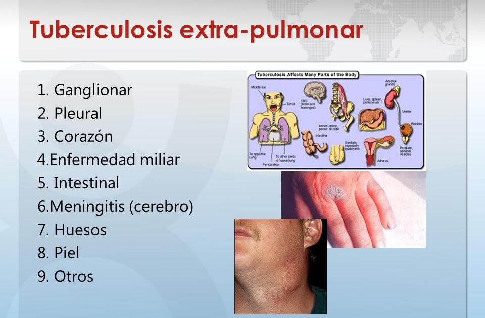 TBC PULMONAR: Tuberculosis Extrapulmonar