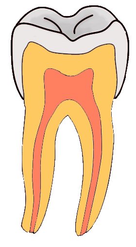 File:Pit-and-Fissure-Caries-GIF.gif