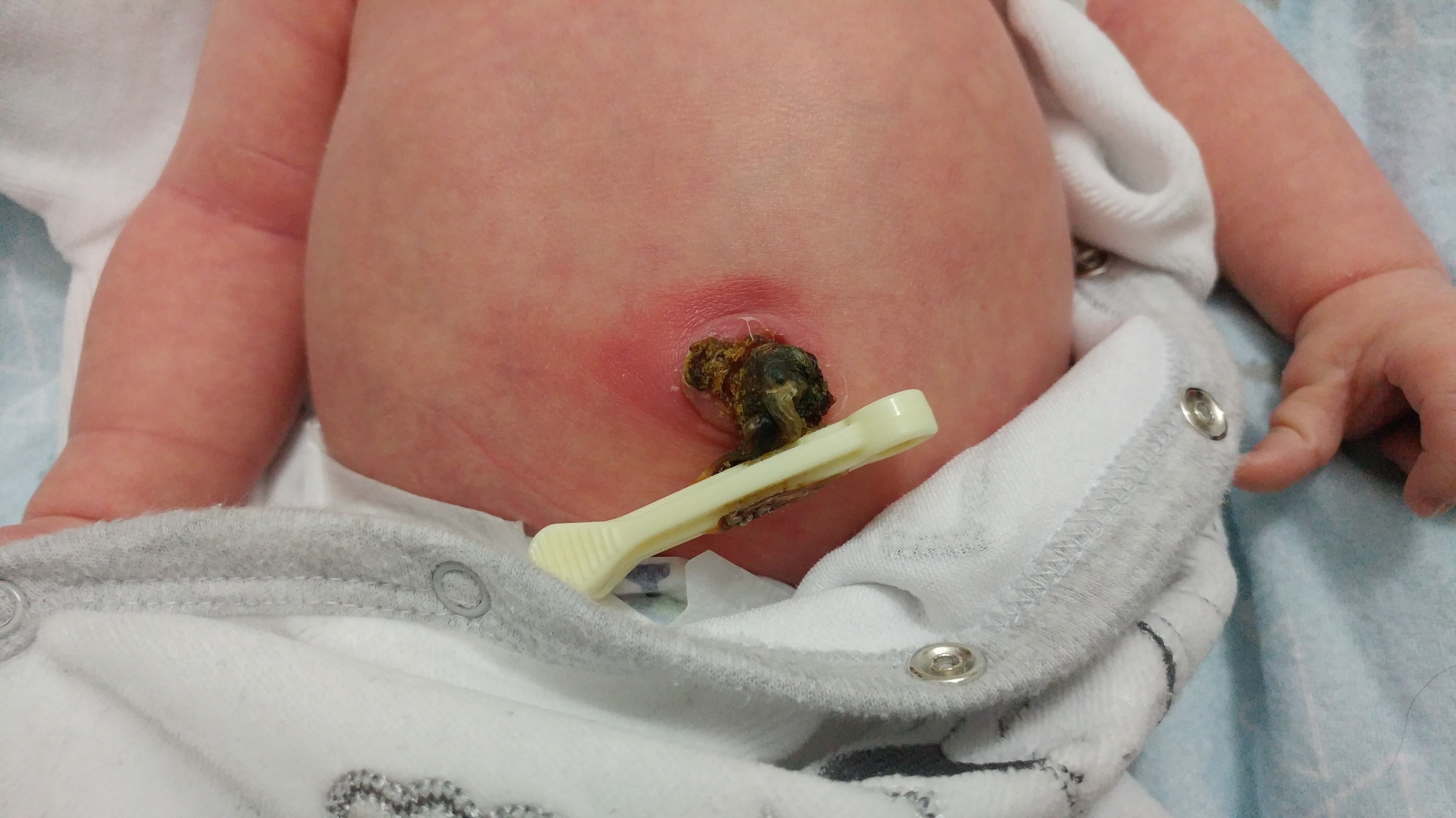 Newborn Baby Umbilical Cord Infection - Newborn baby