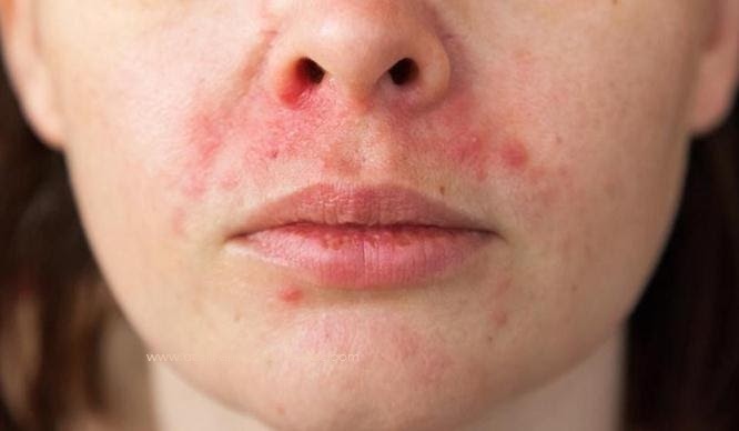 Home Remedies For Perioral Dermatitis (Red Bumps Around The Mouth)