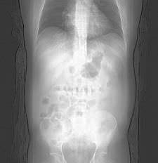 The CT scan of a person's torso.