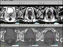 BBC NEWS | Health | Masturbation 'cuts cancer risk'