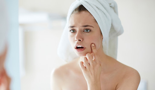 Why summer acne prone skin?