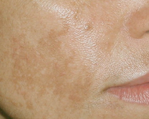 Brown Spots On Face Symptoms Causes Treatment And Prevention Of Diseases