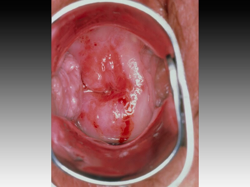 Cervix Care Cervix Care