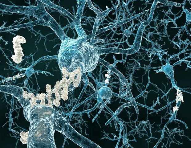 New Therapeutic Target Could Check The Progress Of Alzheimer’s Disease