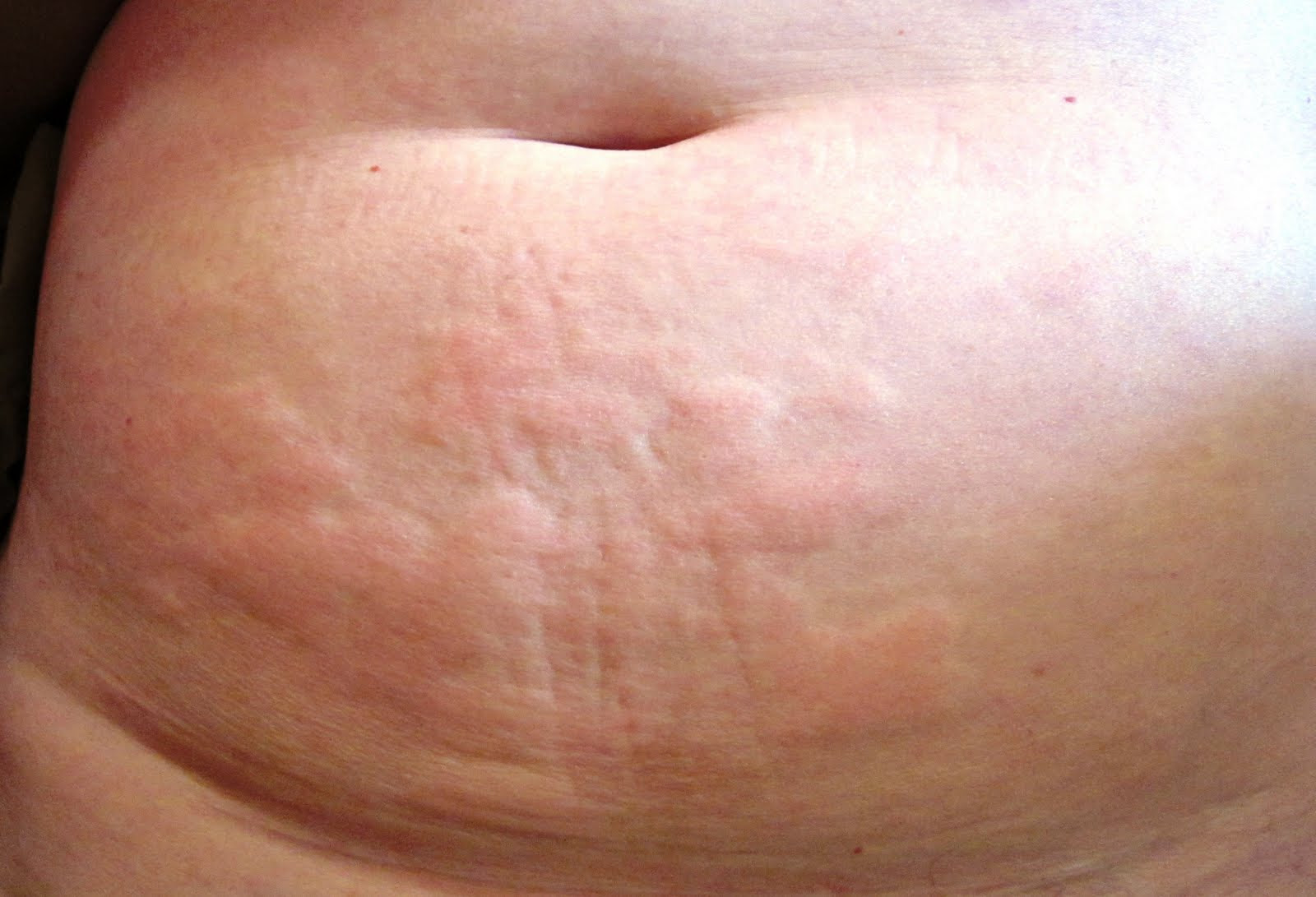 сыпь на груди животе при беременности фото 65