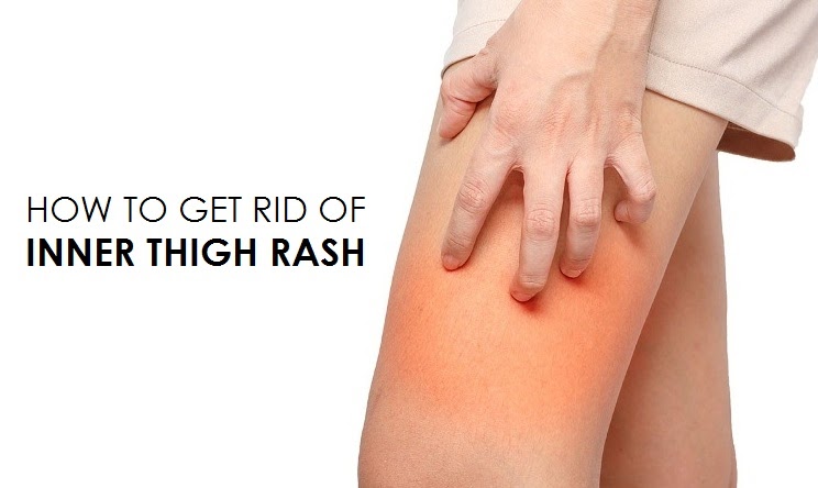 How To Get Rid Of Inner Thigh Rash