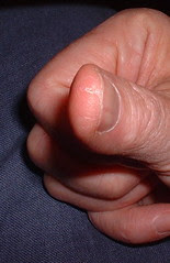 warped finger
