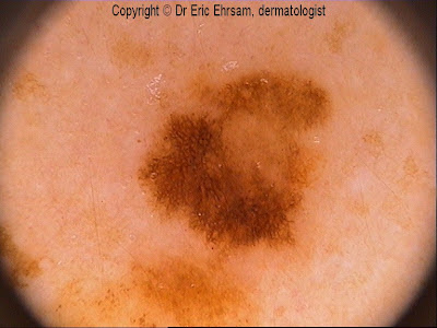 dermoscopy: Compound melanocytic nevus