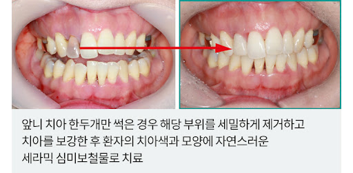 앞니 심미치료 시 꼭 확인해야 할 3가지