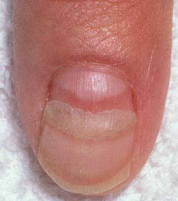 Vertical lines in nails vitamin deficiency - Awesome Nail