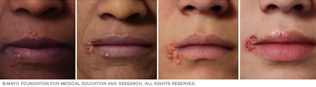 Image of cold sores