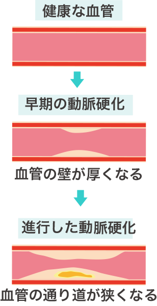 最高のイラスト画像 50 素晴らしい動脈 硬化 イラスト