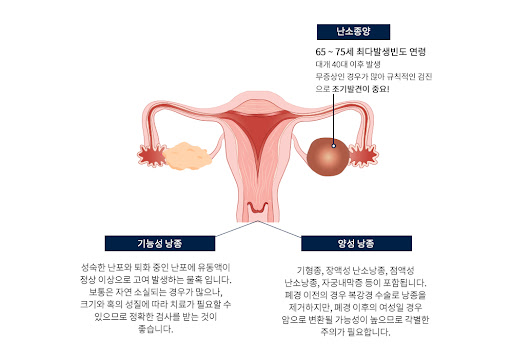 난소낭종 원인, 복통과 팽만감 없어지지 않으면 - 난소낭종의 모든 것