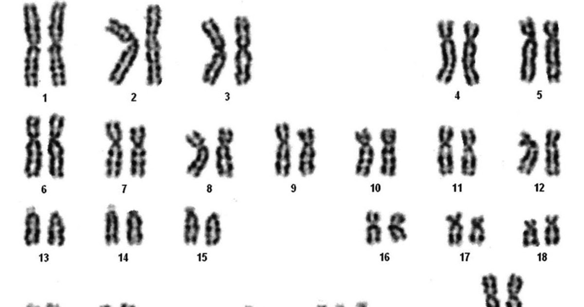 Микроделеция 22 хромосомы. Синдром Лежена кариотип. Лишняя 21 хромосома