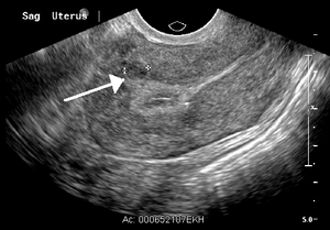 English: A small uterine fibroid within the my...