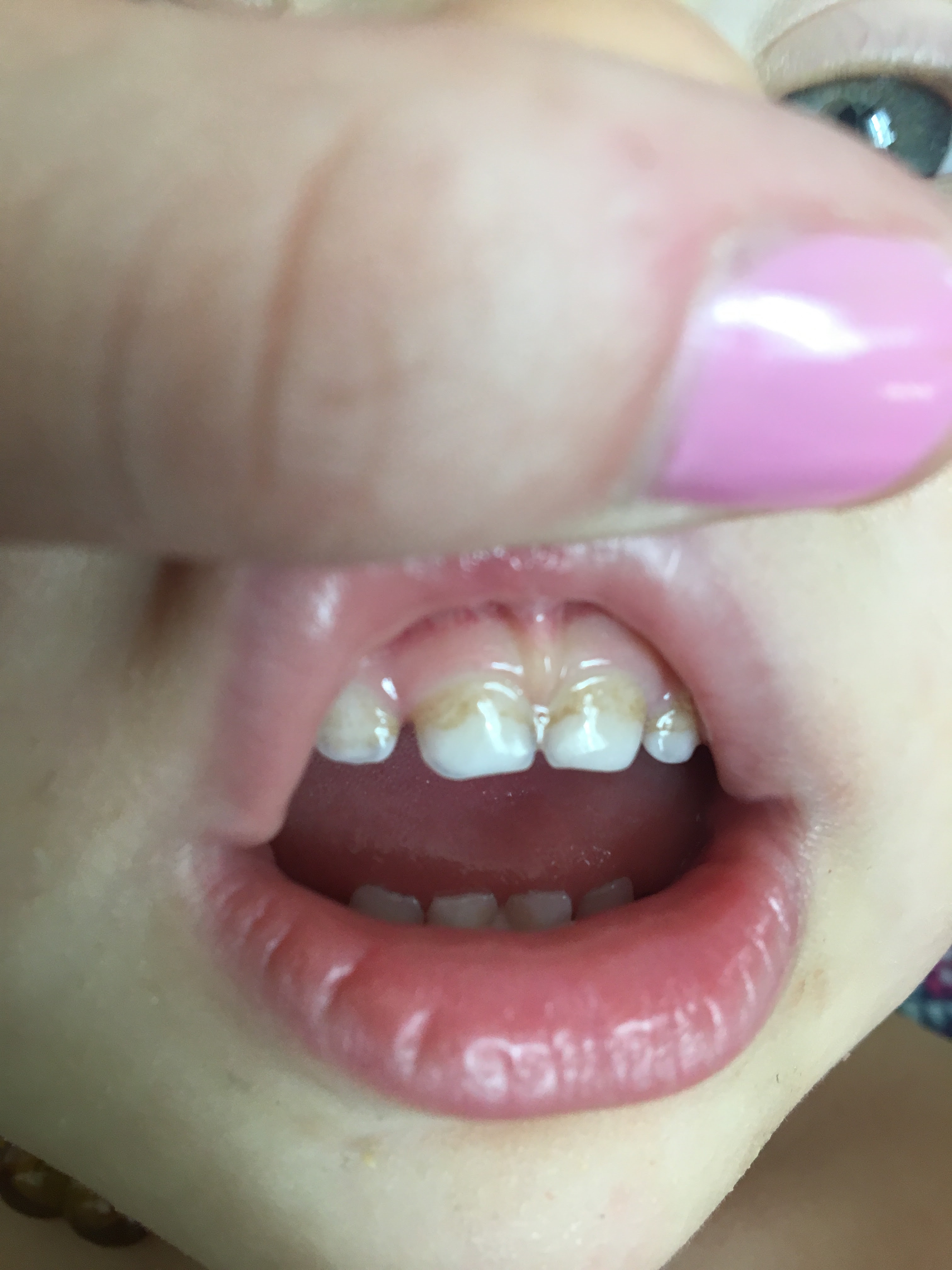 How To Get Rid Of White Spots On Baby Teeth Teeth Poster
