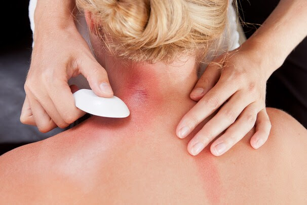 (Bigstock/ ) - Some acupuncturists embrace East Asian technique of scraping, Gua sha, a patient’s back with a spoon until the skin turns red.