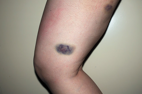 bruised leg_6338 web
