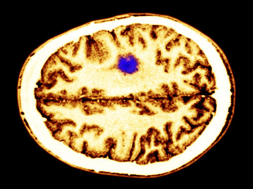 A color-enhanced cerebral MRI showing a glioma tumor.
