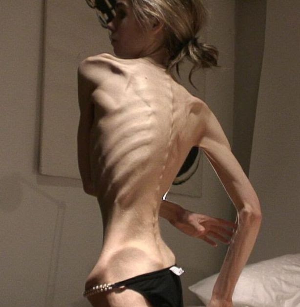 bekekai.com: Wanita Yang Mengidap Anorexia Ekstrim