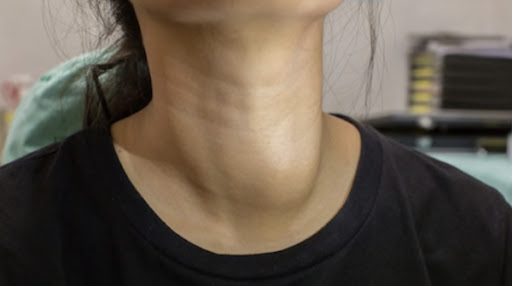 갑상선암의 원인으로 갑상선의 응어리가 나아지지 않는 경우에는 더 늦기 전에