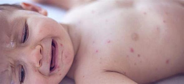 Βρέφος 11 μηνών το πρώτο θύμα της ιλαράς στην Ελλάδα