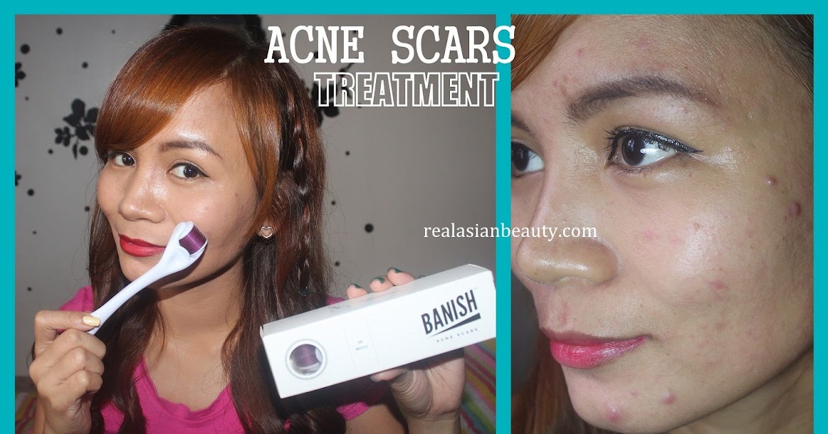 Real Asian Beauty: Banish Acne Scars Derma Roller Demo, Review and  Before-After Pictures
